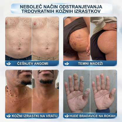 👩‍⚕️👩‍⚕️Uradna trgovina|✅️👩‍⚕️𝐇𝐈𝐒𝐊𝐈𝐍®7 dnevni odstranjevalec kožnih izrastkov in madežev(𝐫𝐨𝐥𝐥-𝐨𝐧 𝐚𝐩𝐥𝐢𝐤𝐚𝐭𝐨𝐫: 𝐛𝐫𝐞𝐳 𝐛𝐨𝐥𝐞č𝐢𝐧 𝐢𝐧 𝐛𝐫𝐚𝐳𝐠𝐨𝐭𝐢𝐧)🌳