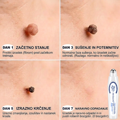 👩‍⚕️👩‍⚕️Uradna trgovina|✅️👩‍⚕️𝐇𝐈𝐒𝐊𝐈𝐍®7 dnevni odstranjevalec kožnih izrastkov in madežev(𝐫𝐨𝐥𝐥-𝐨𝐧 𝐚𝐩𝐥𝐢𝐤𝐚𝐭𝐨𝐫: 𝐛𝐫𝐞𝐳 𝐛𝐨𝐥𝐞č𝐢𝐧 𝐢𝐧 𝐛𝐫𝐚𝐳𝐠𝐨𝐭𝐢𝐧)🌳