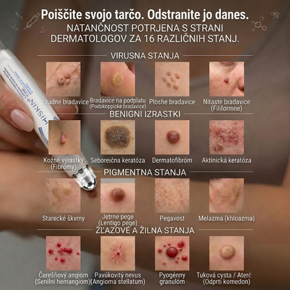 👩‍⚕️👩‍⚕️Uradna trgovina|✅️👩‍⚕️𝐇𝐈𝐒𝐊𝐈𝐍®7 dnevni odstranjevalec kožnih izrastkov in madežev(𝐫𝐨𝐥𝐥-𝐨𝐧 𝐚𝐩𝐥𝐢𝐤𝐚𝐭𝐨𝐫: 𝐛𝐫𝐞𝐳 𝐛𝐨𝐥𝐞č𝐢𝐧 𝐢𝐧 𝐛𝐫𝐚𝐳𝐠𝐨𝐭𝐢𝐧)🌳
